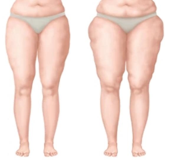 Lip�dem/Lenf�dem